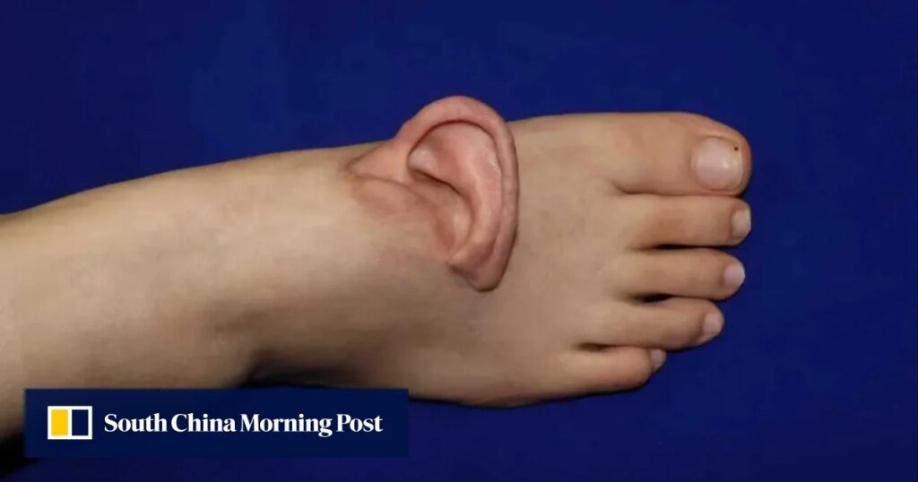 Chinese Surgeons Make History by Transplanting Patient's Ear to Her Foot Following Accident
