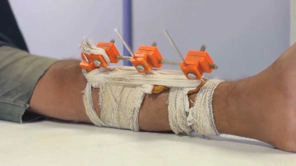 Gaza physicians employ 3D technology to preserve limbs damaged by Israel, avoiding amputation.