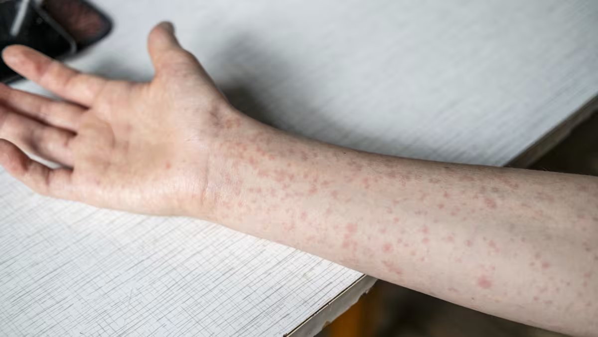 Singapore reports 12 additional measles cases, with 4 linked in a cluster.